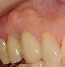 歯ぐきの再生治療・CASE2